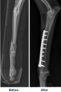 before x-ray photo for broken bone, after x-ray photo of bone fixed with plate holding it