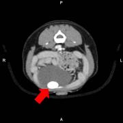 diagnostic image showing a bladder stone