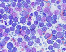 A microscopic view of lymphoma cells