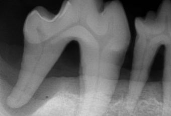 X-ray of a tooth