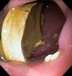 An endoscopic image of a tennis ball in the stomach of a dog