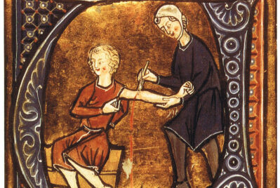 A historical illustration of bloodletting