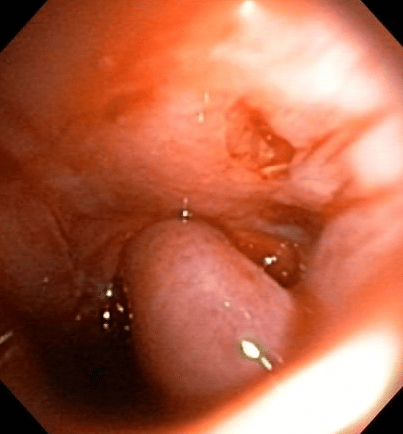 A feline polyp