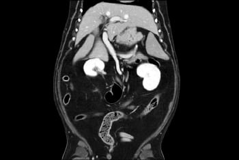 CT scan of kidney