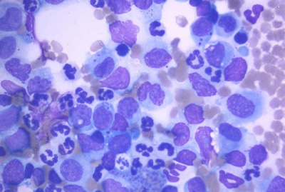 Feline lymphoma under a microscope